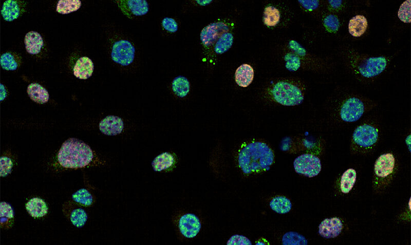 Image: Under a microscope, DNA repair is visible as bright green spots (“foci”) in the blue-stained cell DNA. Orange highlights actively growing cancer cells (Photo courtesy of WEHI)